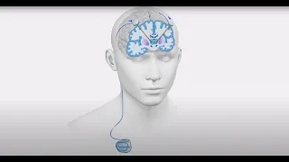 Deep Brain Stimulation (DBS) for Parkinson’s Disease, Essential Tremor, and Epilepsy