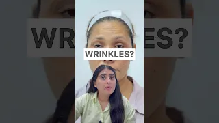 Wrinkles | How to get rid of forehead wrinkles| Botox| Botox treatment for face #skincare #wrinkles