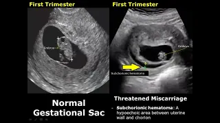 Uterus Ultrasound Normal Pregnancy Vs Miscarriage Image Appearances | Intrauterine Pregnancy USG