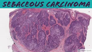 Sebaceous carcinoma: 5-Minute Pathology Pearls