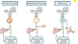 ACROMEGALY AND GIAGANTISM