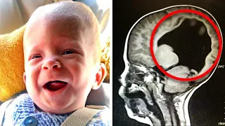 Das Baby wurde "ohne Gehirn" geboren. 3 Jahre später entdecken die Ärzte ein Wunder