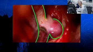 Episode 7: Clipping of a Classic Posterior Communicating Artery Aneurysm