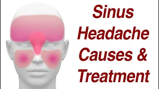 Sinus Headaches: Causes & Treatment