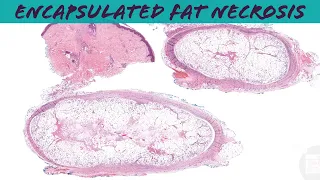 Post-traumatic fat necrosis (encapsulated subcutaneous fat necrosis) pathology dermpath dermatology