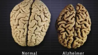 Understanding #Alzheimer's Disease #dementia #alzheimer