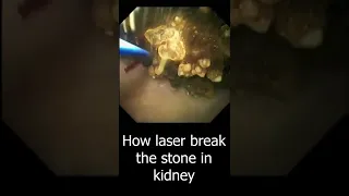 How the Laser Break Kidney stone | Laser Lithotripsy