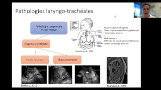 Dr Lilou Casteil Sténoses laryngo trachéales et paralysies de l'enfant 2021.mp4