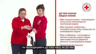 Перша допомога: опіки