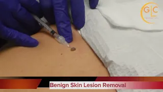 Mole Removal by Dr Tariq Ali Khan, MD
