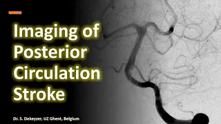 Basilar artery thrombosis and beyond - Imaging of posterior circulation stroke.