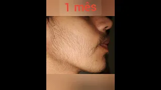 Evolução 3 meses de minoxidil Kirkland...