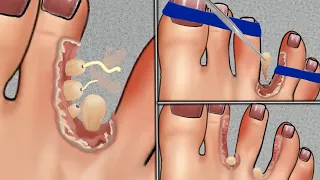 ASMR ~ Treatment athlete`s foot. Warts between toes. Foot care animation by Ksenia #asmranimation