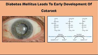 Why Diabetes Mellitus Leads To Early Development Of Cataract || Diabetes And Cataract