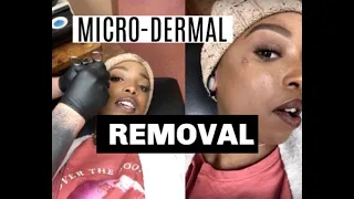 MicroDermal Piercing Removal | Piercing Update