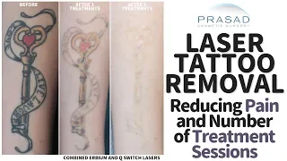 How Tattoos Removal can be Done with Less Pain, and Fewer Treatment Sessions