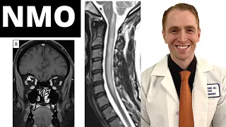 Neuromyelitis Optica (NMO) [Symptoms, Diagnosis, MRI Findings, Treatment, Clinical Trial Results]