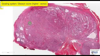 Prostate gland: Acinar adenocarcinoma Microscopy - Talking slide