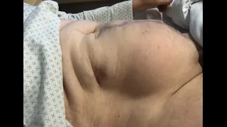 Large postoperative ventral hernia repair (М1-2-3W3R0) with bilateral TAR