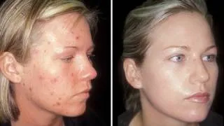 HOW TO: CURE ACNE!!!! - CLEAR SKIN IN ONE WEEK