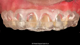 Digitally Guided Aesthetic Crown Lengthening procedure|Gingivectomy Guide|3D printing.