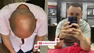 hair transplant before / after , Bellus clinic, Istanbul / Turkey