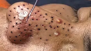 Blackhead Removal With Sac Dep Spa @1000236