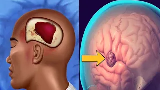 Craniectomy brain surgery. 3D animation