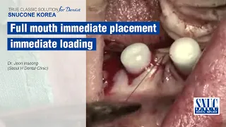 [SNUCONE IMPLANT]Full mouth immediate placement & immediate loading