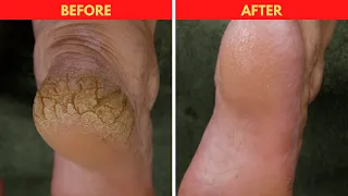 Severe Callused And Cracked Heels Transformation #shorts