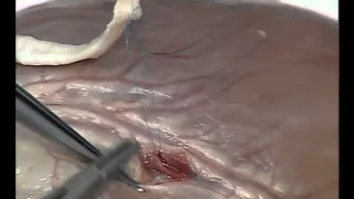 Distal Anastomosis: Parachute Technique CABG Cardiac Surgery