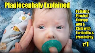 #1 Plagiocephaly Explained: Pediatric Physical Therapy with a Child with Torticollis & Prematurity