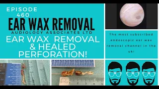 EAR WAX REMOVAL & HEALED PERFORATION - EP460