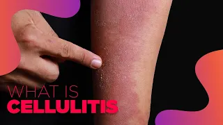 What is Cellulitis - Symptoms and Treatment Options