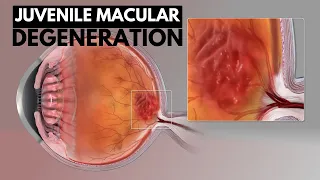 Juvenile Macular Degeneration: Causes, Symptoms and Treatment.