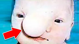 When This Newborn’s Mother First Saw His Severely Deformed Face, She Actually Wished He Would Die