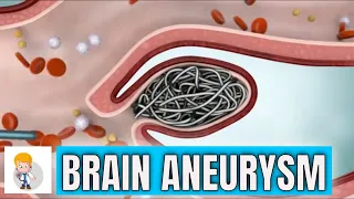 Brain (cerebral) Aneurysm: Types, symptoms, and surgical repair