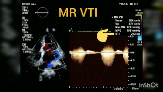 How to quantify Mitral regurgitation with PISA method?