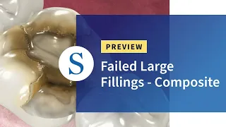 Failed Large Fillings - Composite, Patient Education Preview