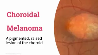 Malignant choroidal melanoma