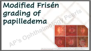 Modified Frisén Grading of Papilledema