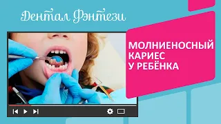 Молниеносный кариес у ребёнка😫 Результат спасённой улыбки в конце видео🦷