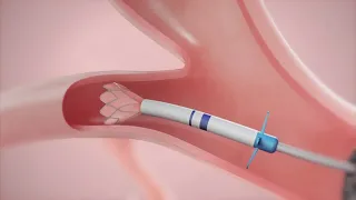 Newly approved procedure allows patients with COPD to breathe easier without invasive surgery