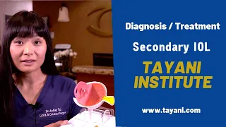 Secondary IOL | Tayani Institute