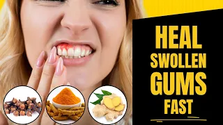 How To Heal Swollen Gums Naturally (100% Fast Result)