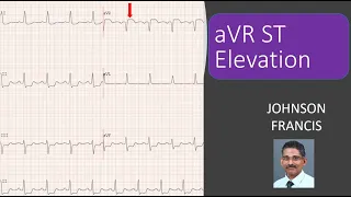 ECG Shorts - aVR ST Elevation