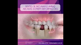 O QUE ACONTECE COM OS DENTES VIZINHOS QUANDO PERDEMOS UM DENTE? A importância do implantes dentario