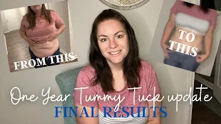 1 YEAR TUMMY TUCK UPDATE / The final chapter!!!
