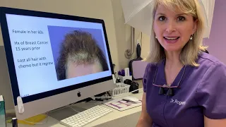 Hair Loss After Chemo Therapy Treated