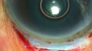 Let us learn MSECS i.e. " manual sutureless extracapsular cataract surgery"